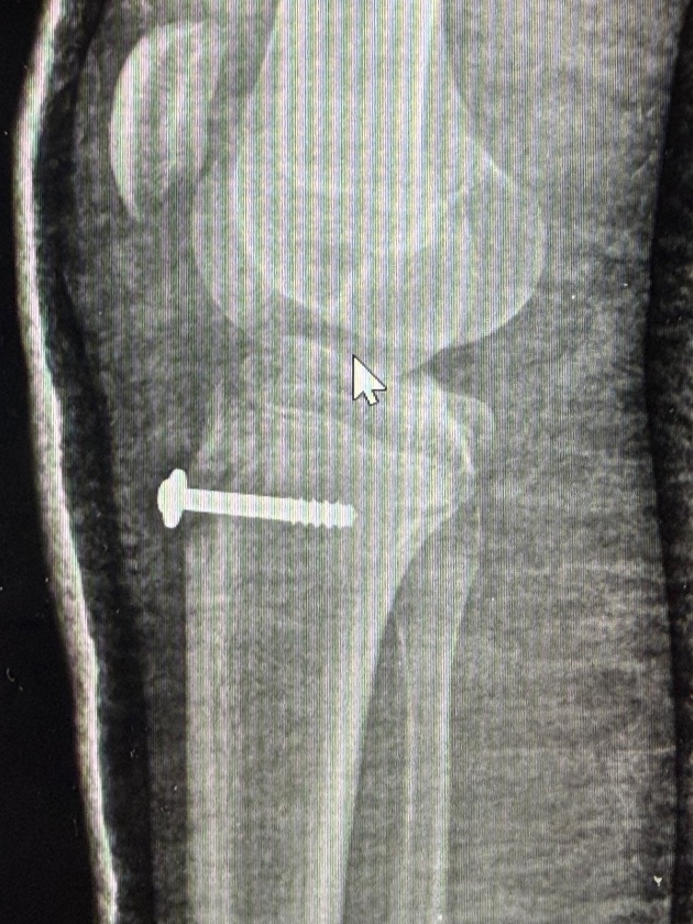 Osgood-Schlatter – ból kolana u młodego sportowca