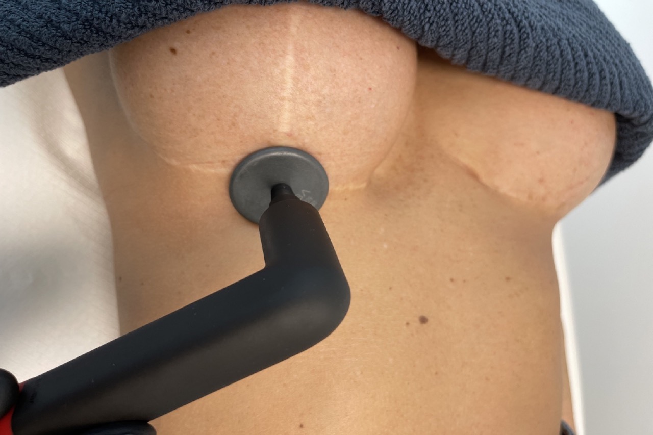 Profesjonalne usuwanie blizny